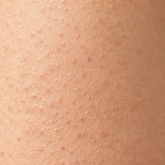 Hình minh họa da sần, dày sừng