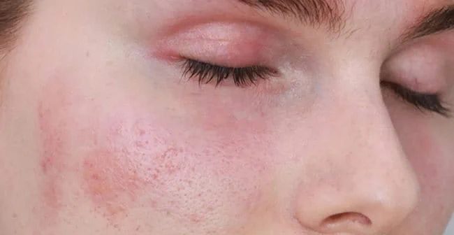 Da nhạy cảm là gì? Cách xây routine dịu nhẹ 4 bước